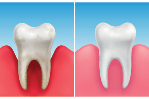 What Is A Periodontal Scaling And Root Planing