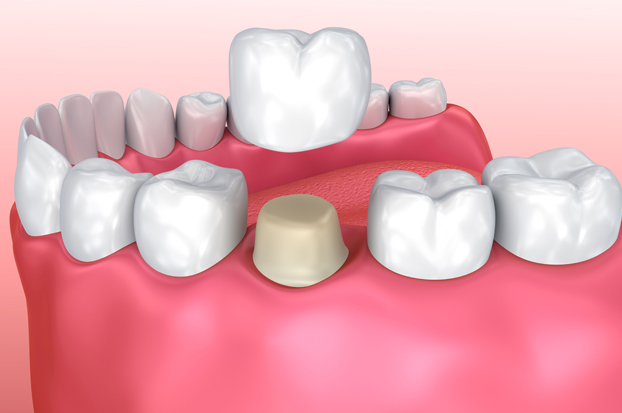 Why Are Dental Crowns Needed