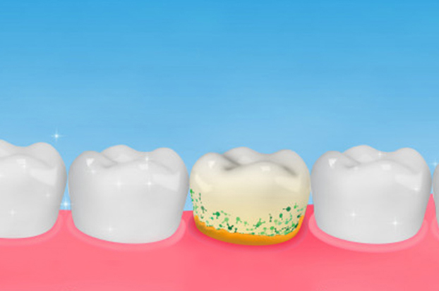 Why Is A Periodontal Scaling And Root Planing Needed