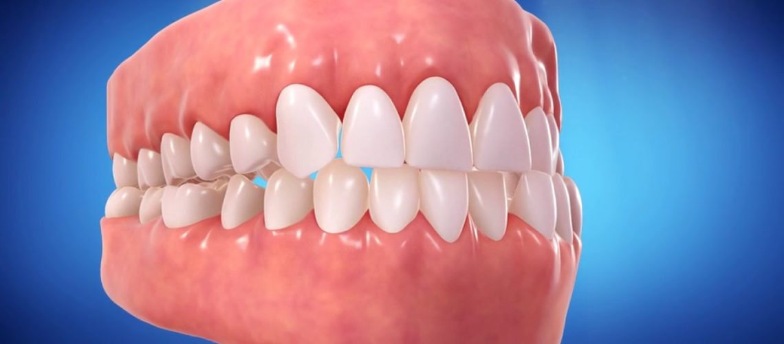 Invisalign Attacks What Are They And What Are They For